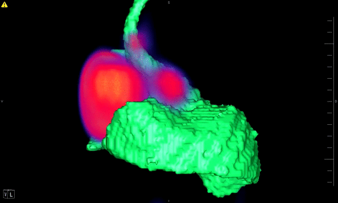 Animated image of PET/CT showing heart, lungs and bone structure