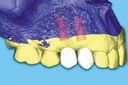A faster route to dental implants