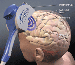 Image showing magnetic field pulses being used on a patient during treatment of depression using TMS therapy.