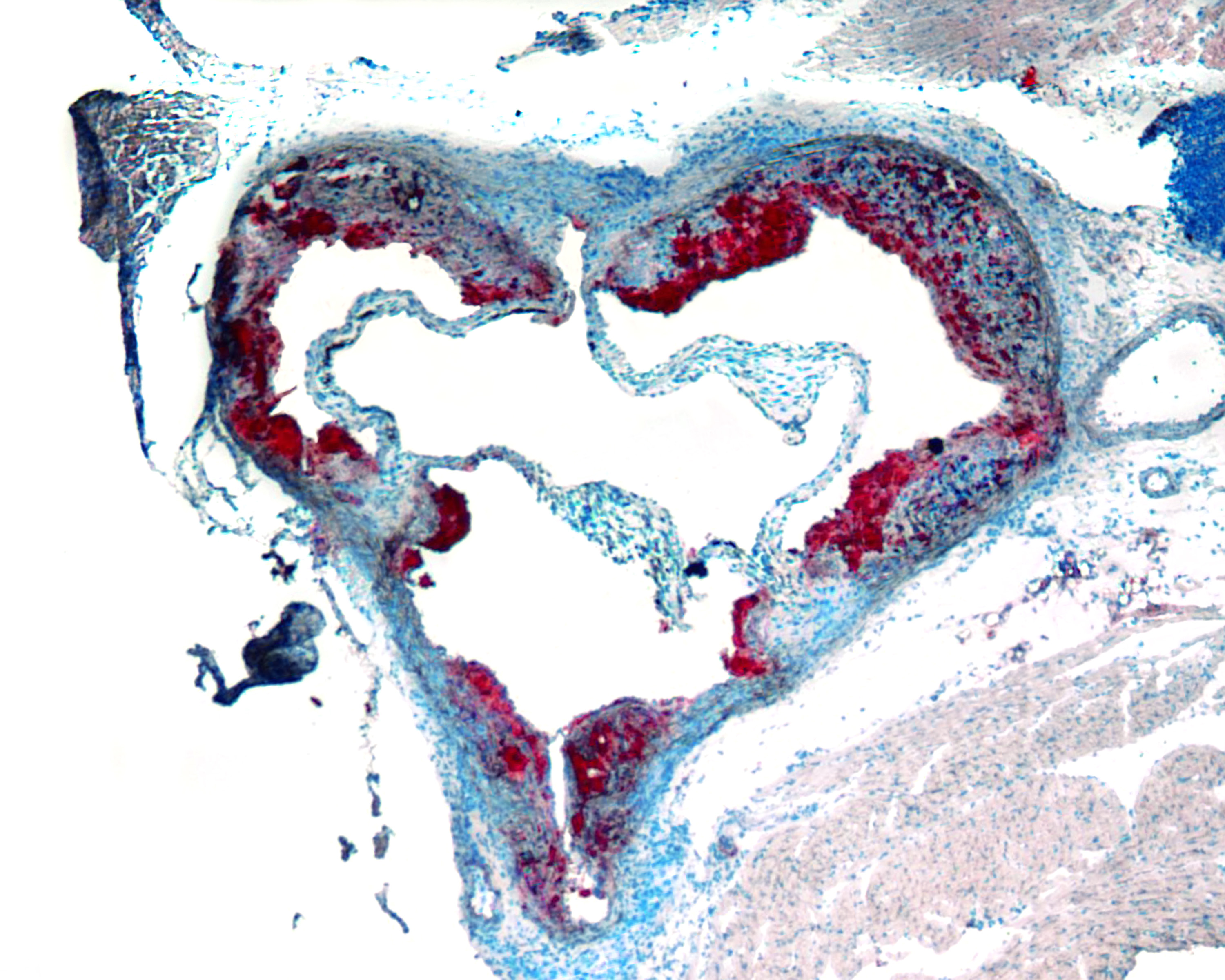 Aortic Heart Valve