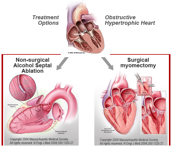 Illustration showing two treatment options for hypertrophic Cardiomyopathy; non-surgical and surgical.