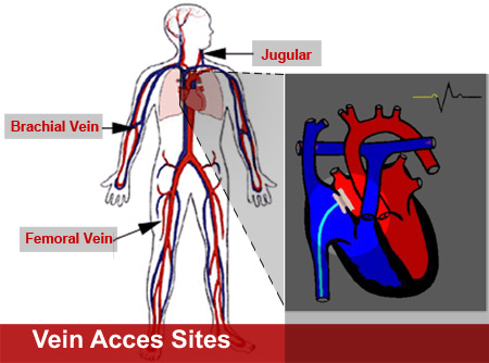 Diagram showing two approaches used in coronary stenting