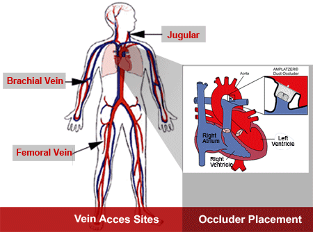 diagram showing area of heart occluder is placed