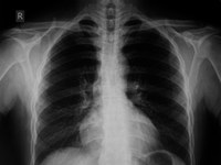 chest x-ray