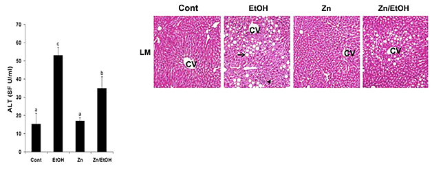 zinc therapy for alcoholic hepatitis slides