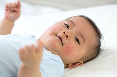 baby with eczema