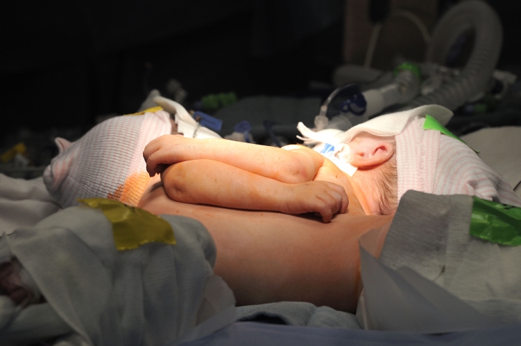 Conjoined twins separated by UofL pediatric surgical team