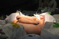 Conjoined twins separated by UofL pediatric surgical team