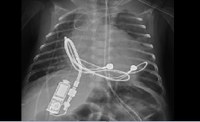 In first in-human use, UofL & Norton physicians implant tiny pacemaker, saving infant’s life