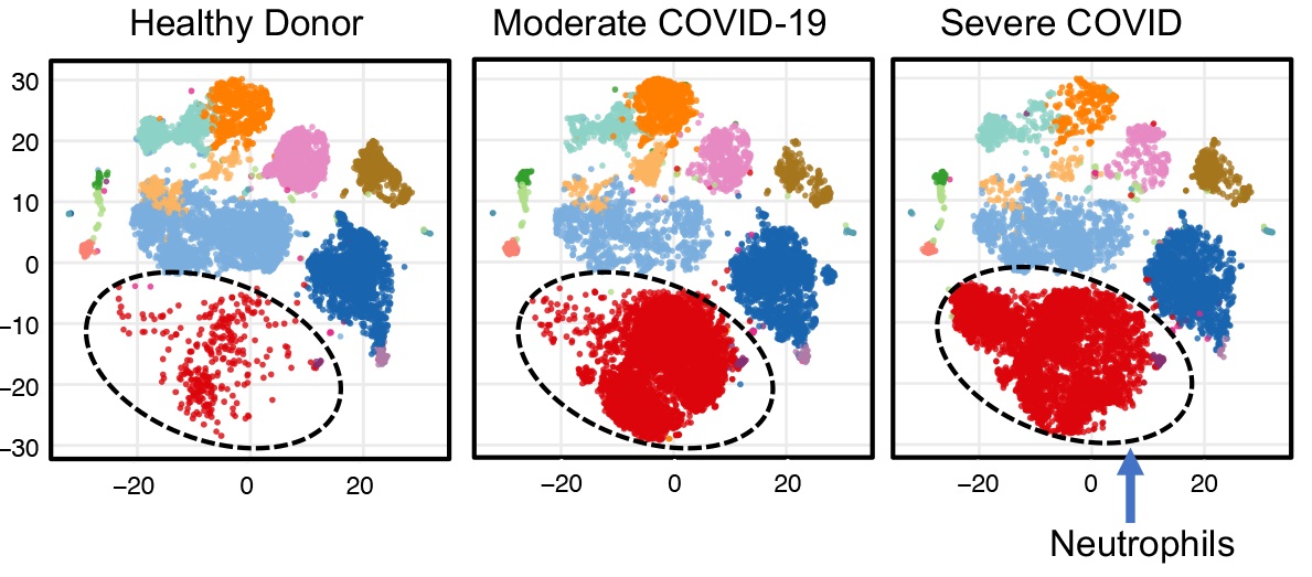 UofL immunologist discovers biomarker warning of cellular crisis that could cause death in COVID-19 patients