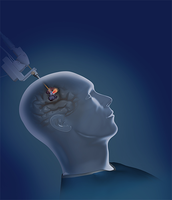 UofL neurosurgeons now providing robotic laser therapy for brain tumors, lesions